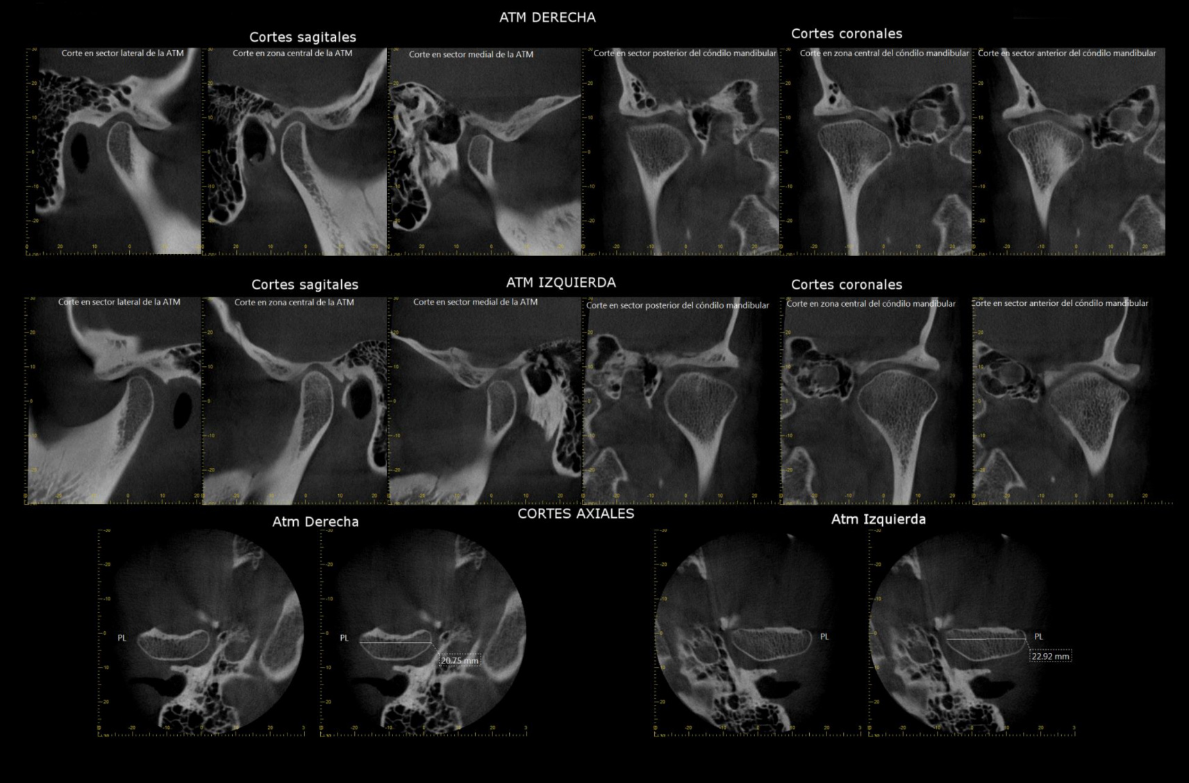 caso-tomografia-cone-beam2